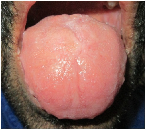 Large tongue