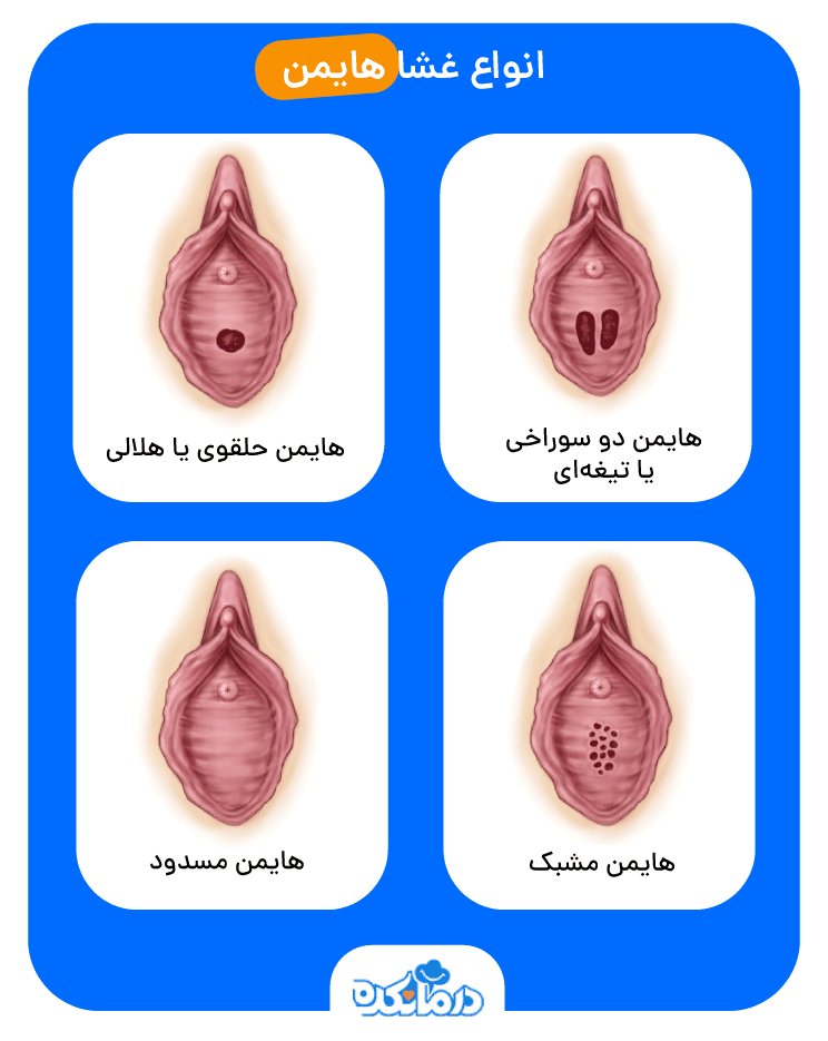 دوختر بکارت زند