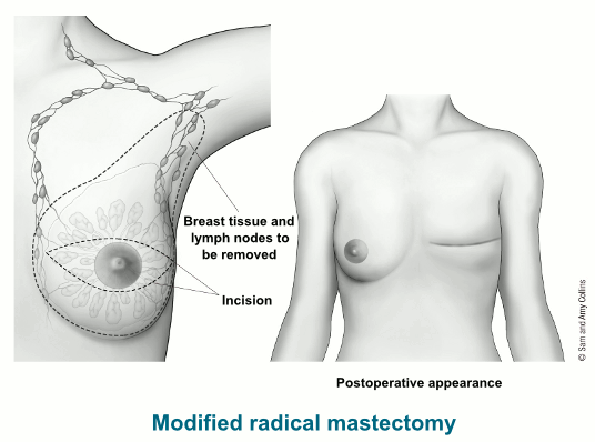 Types of mastectomy