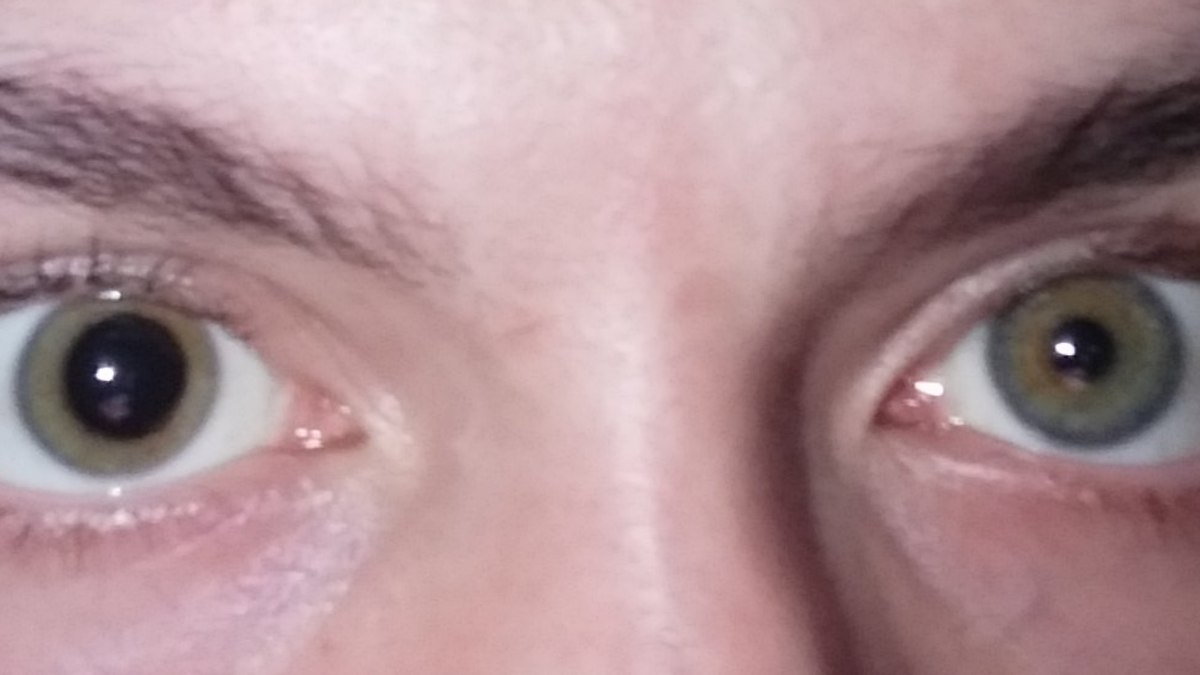 How Drugs Affect the Eye: Dilation, Pinpoint Pupils, Redness & More