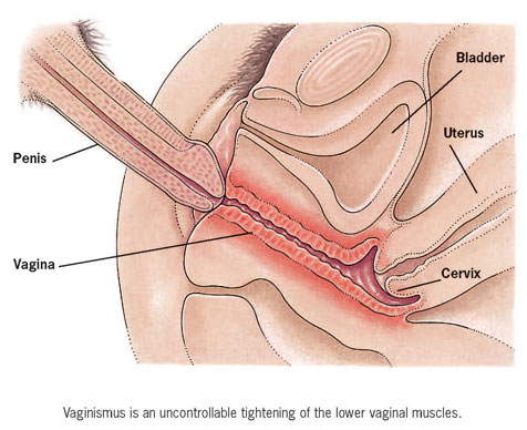 Self-Exam: Vulva and Vagina