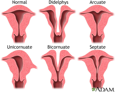 How Is Uterine Didelphys Diagnosed?